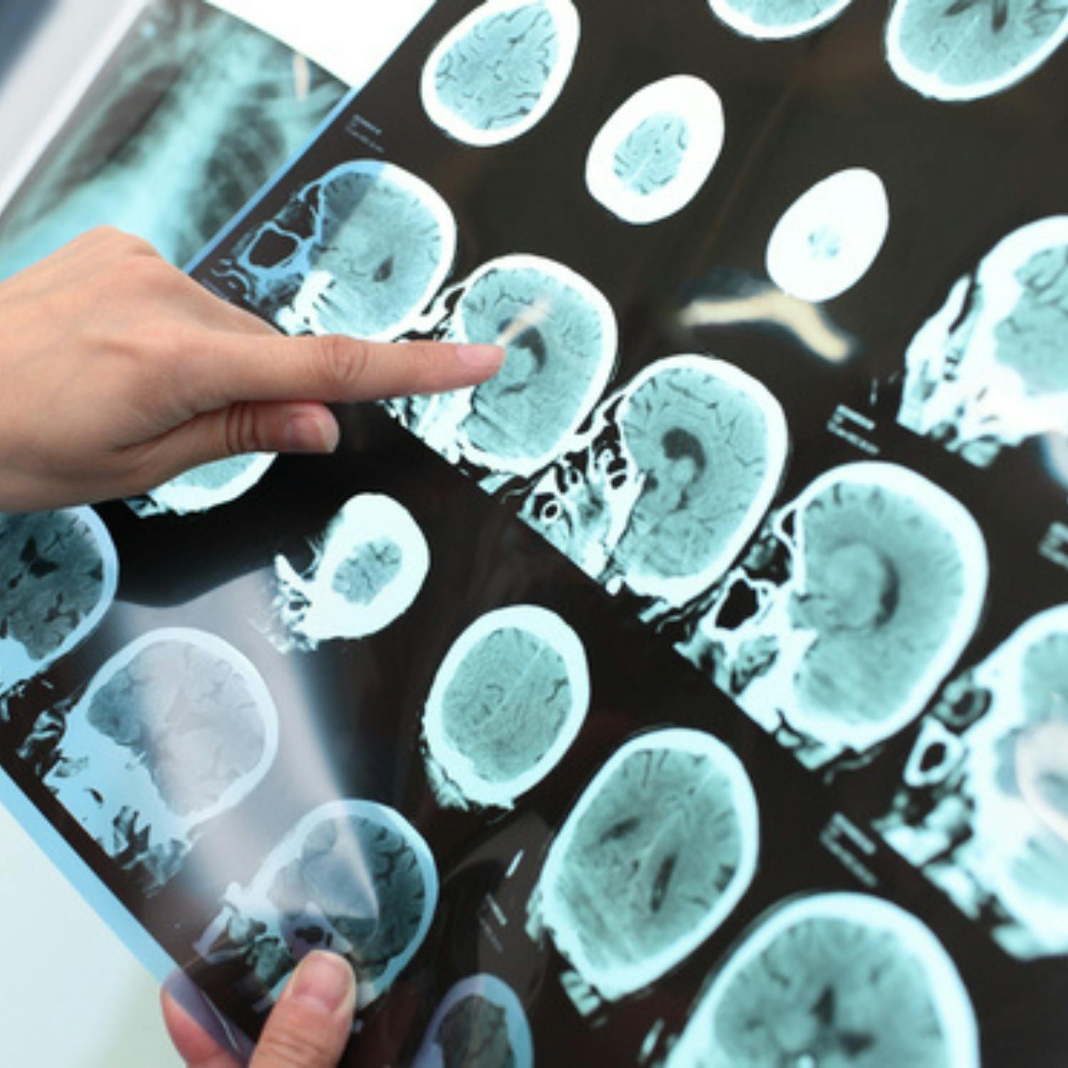 Recent Alzheimer's breakthroughs in science