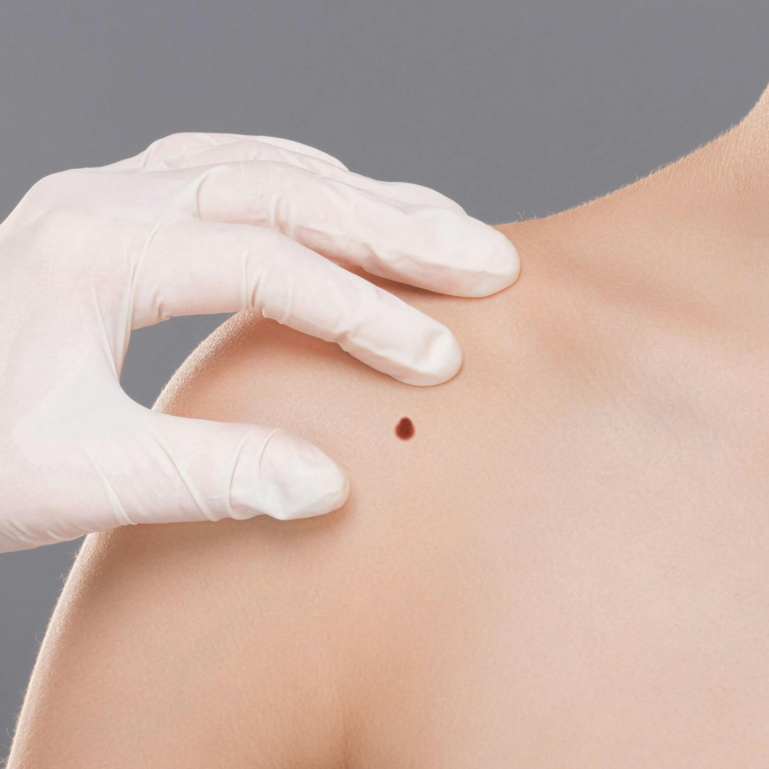 What is your experience with skin cancer? episode artwork