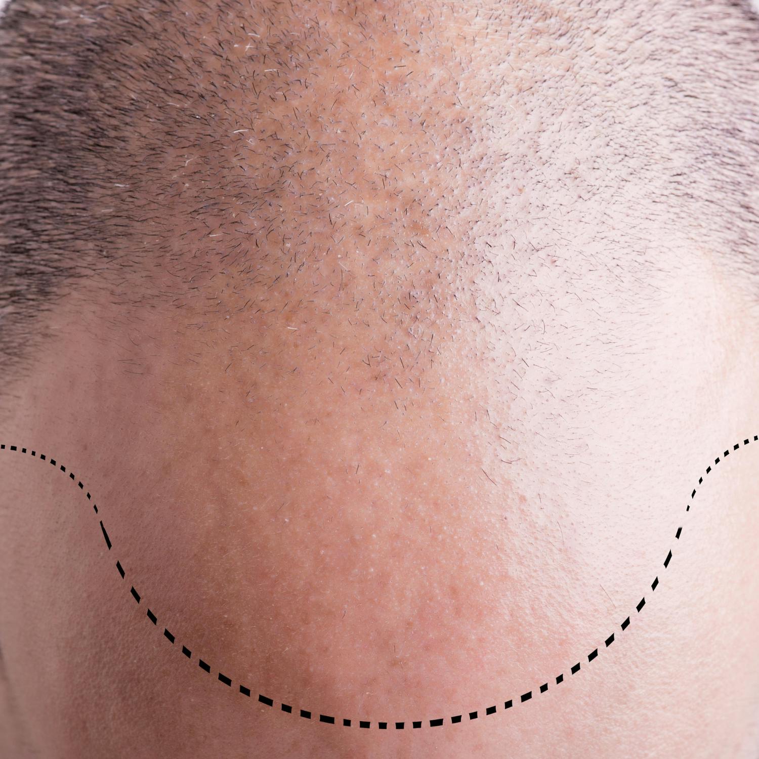 Hair transplants for men have become increasingly popular