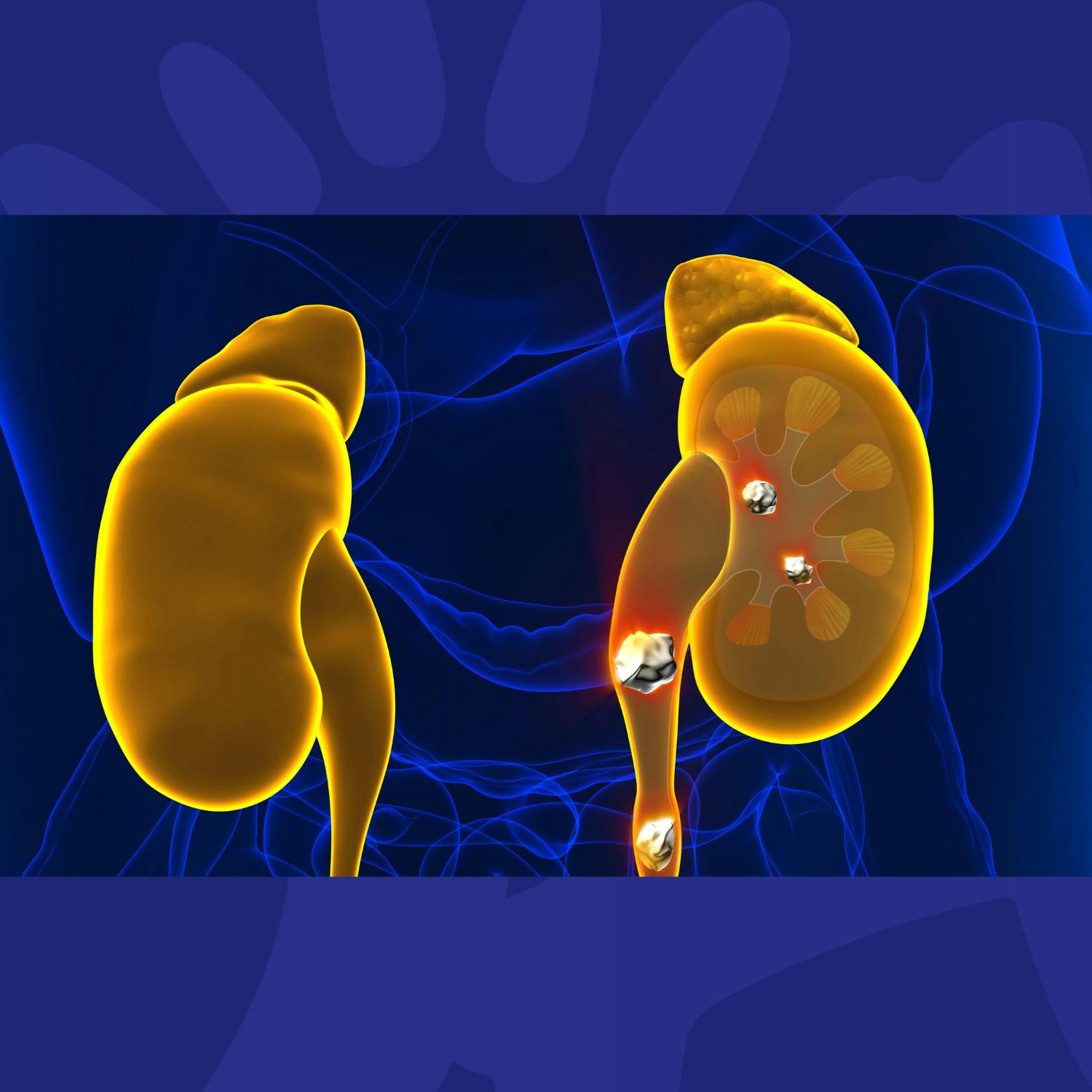 Are Kidney Stones More Painful Than Child Birth? Image