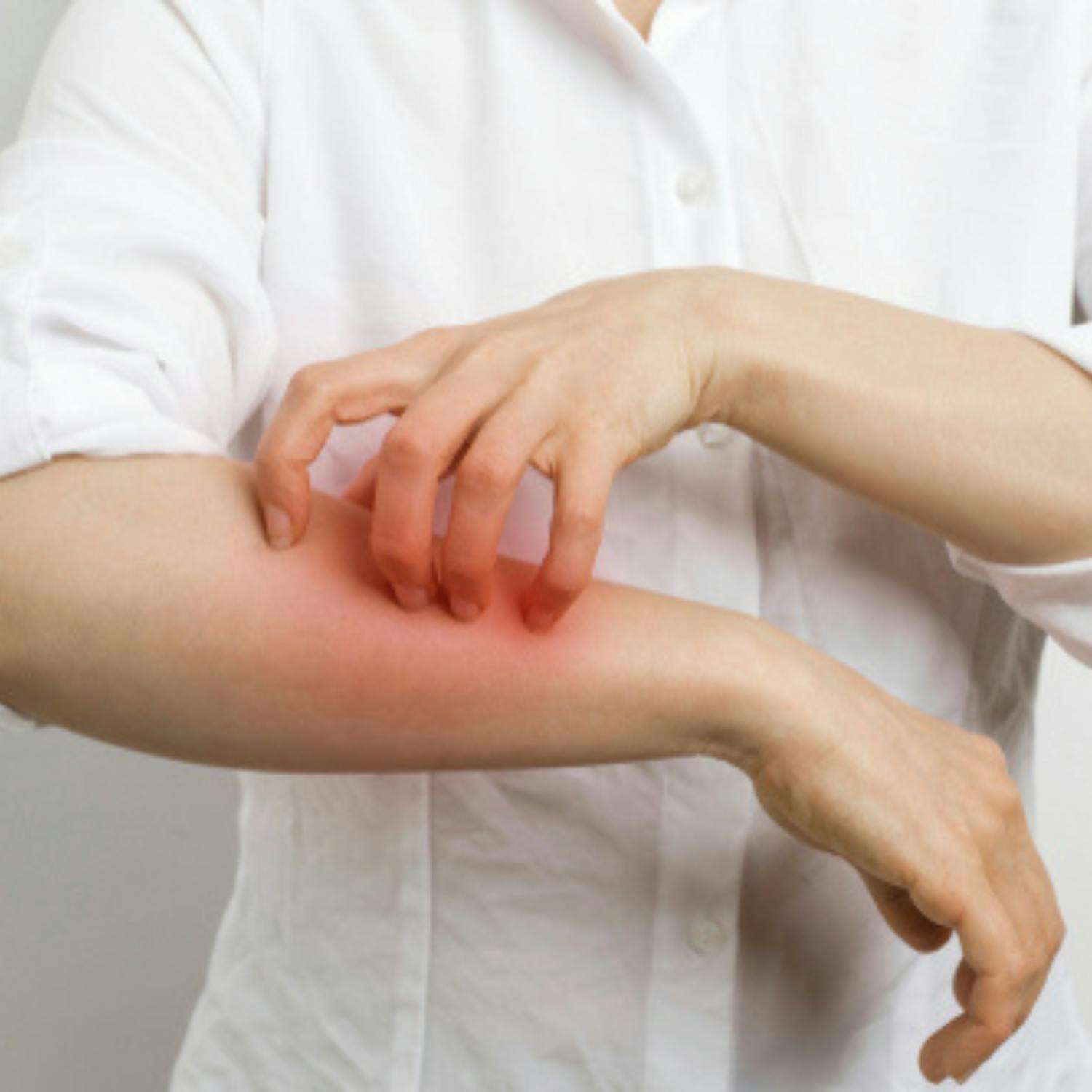 A rise in scabies cases