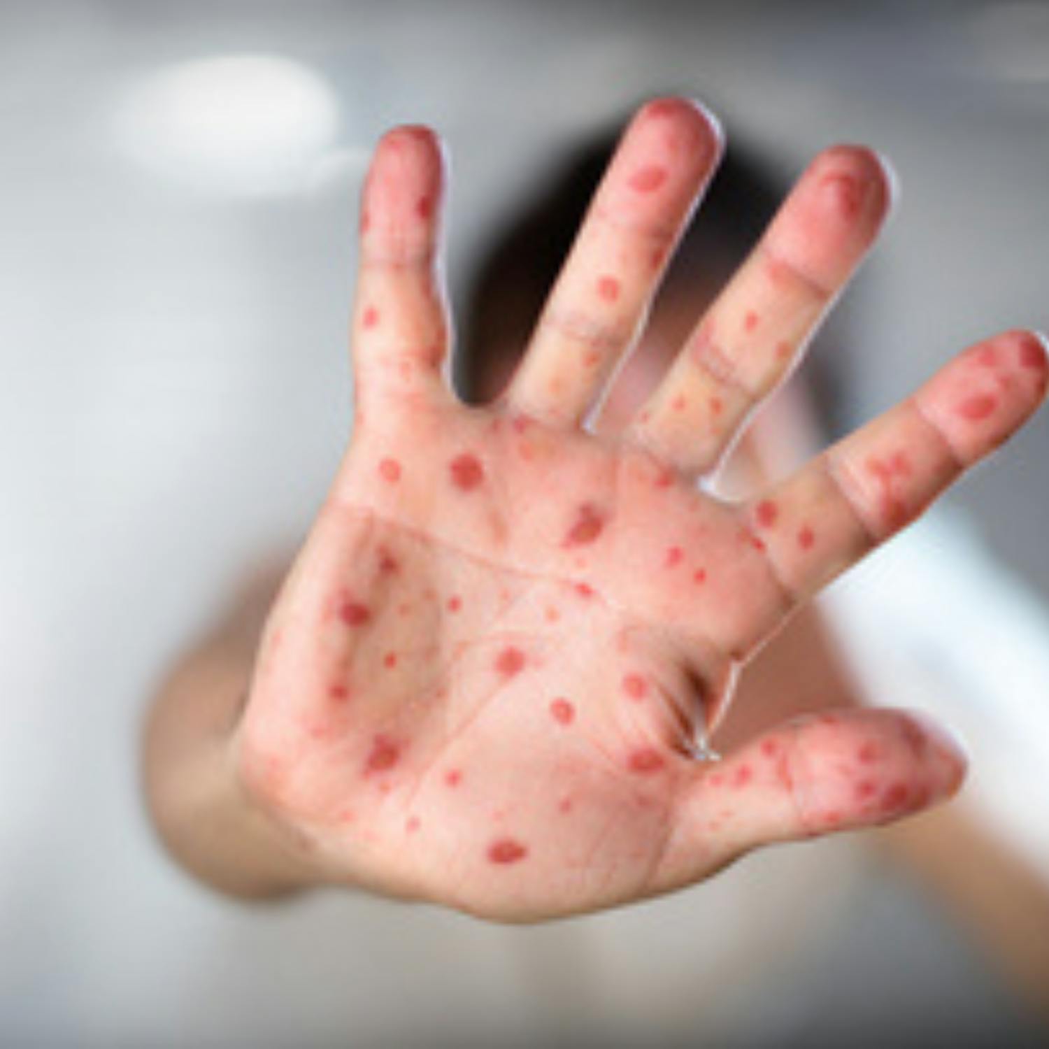 Ask The Expert: On measles