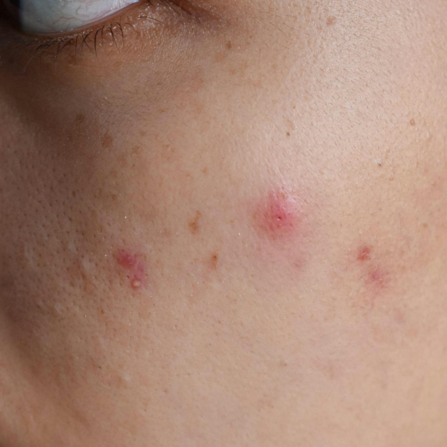 How do you deal with adult acne?