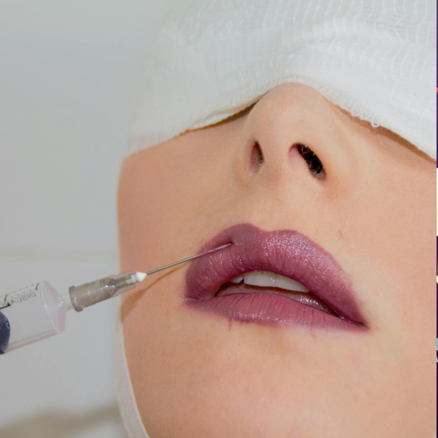 Dangers of receiving unregulated botox treatment