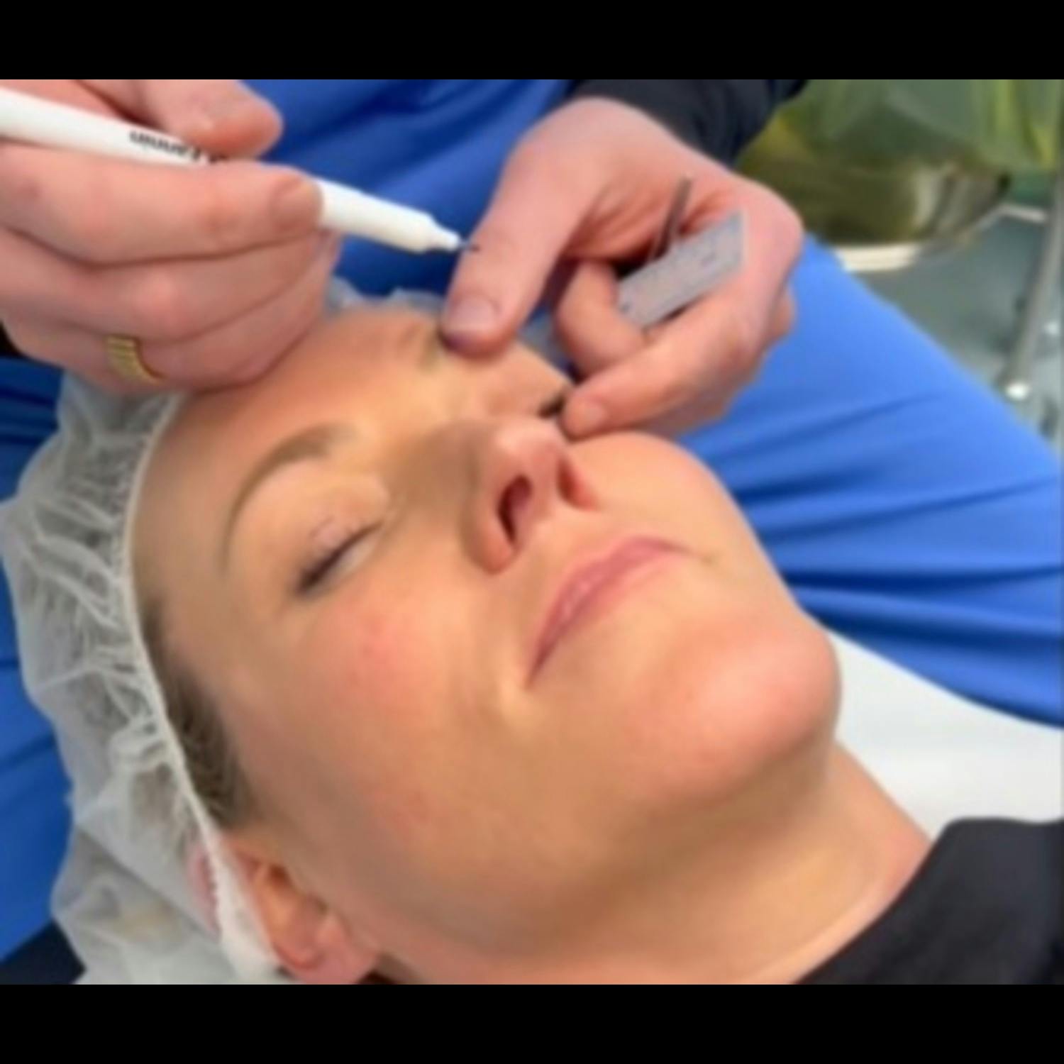 Blepharoplasty explained by Liz Dwyer Blepharoplasty explained by Liz Dwyer