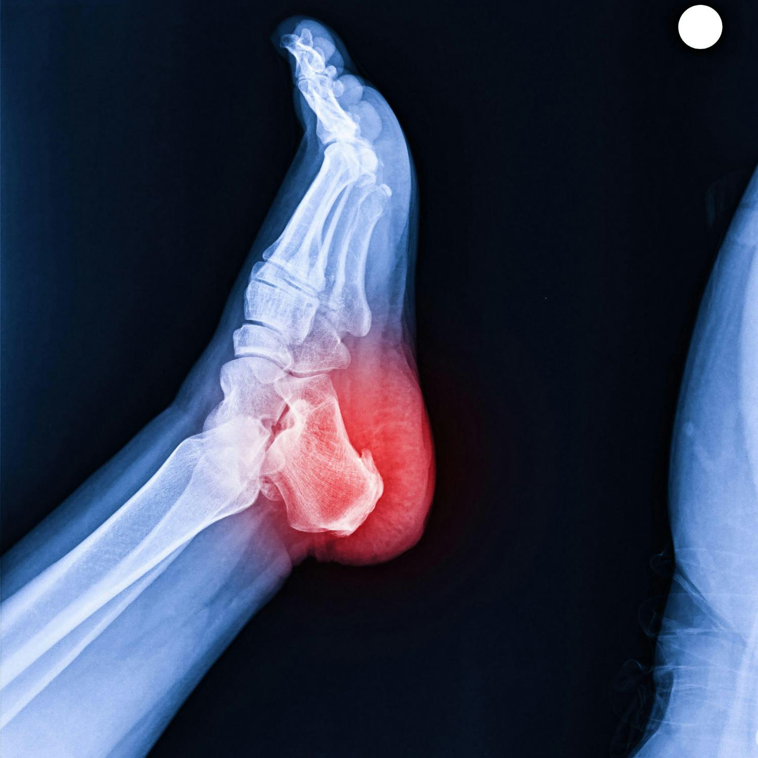 Managing pain while you wait for a physio appointment