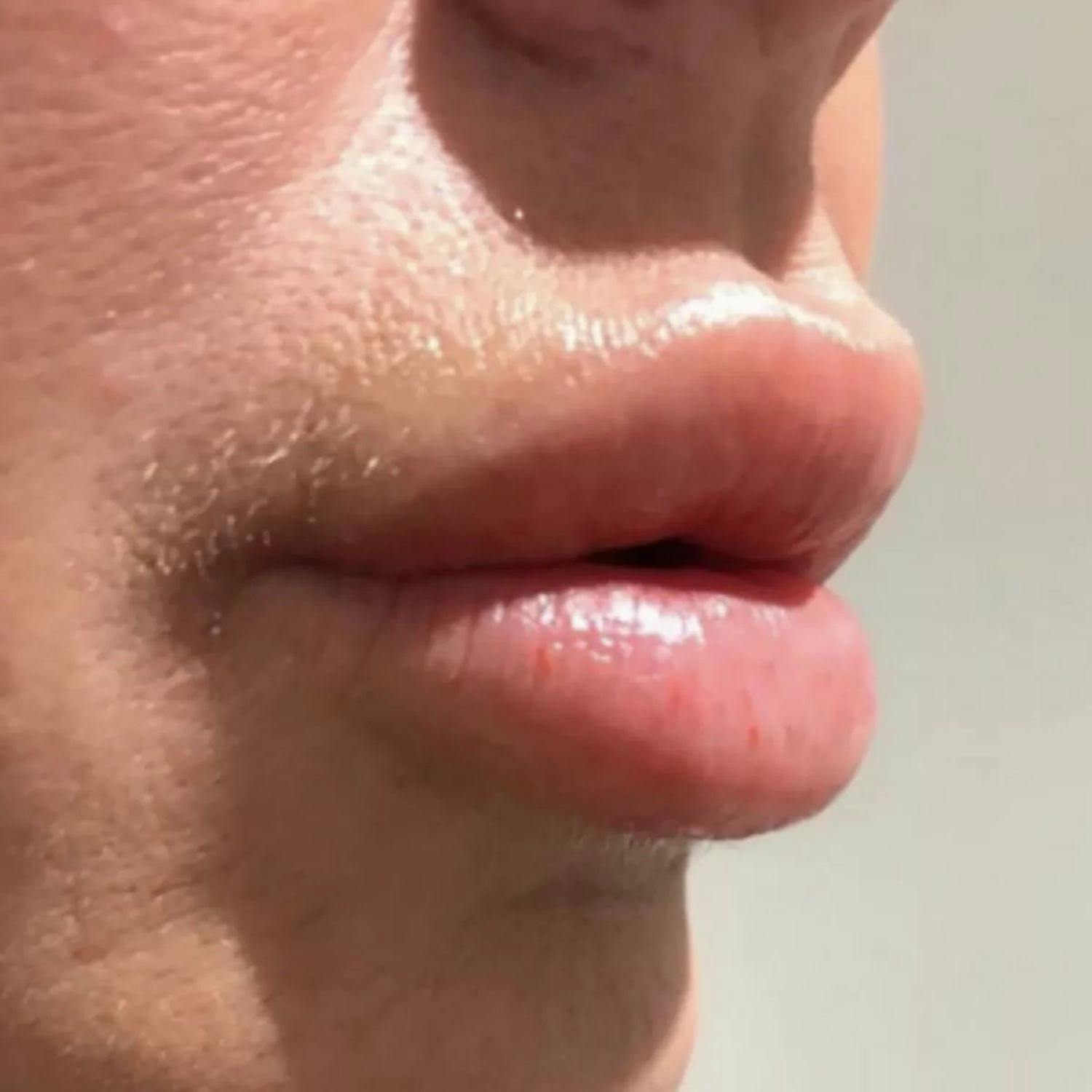 Woman To Protest Outside Dublin Clinic That Gave Her Daughter Lip Filler Injections