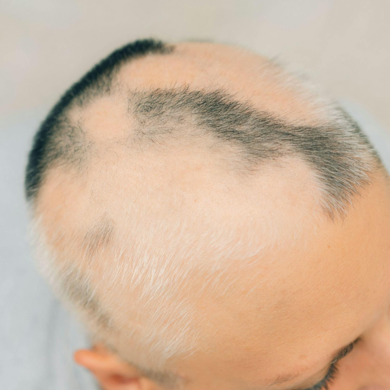 Living with Alopecia - what is it like?