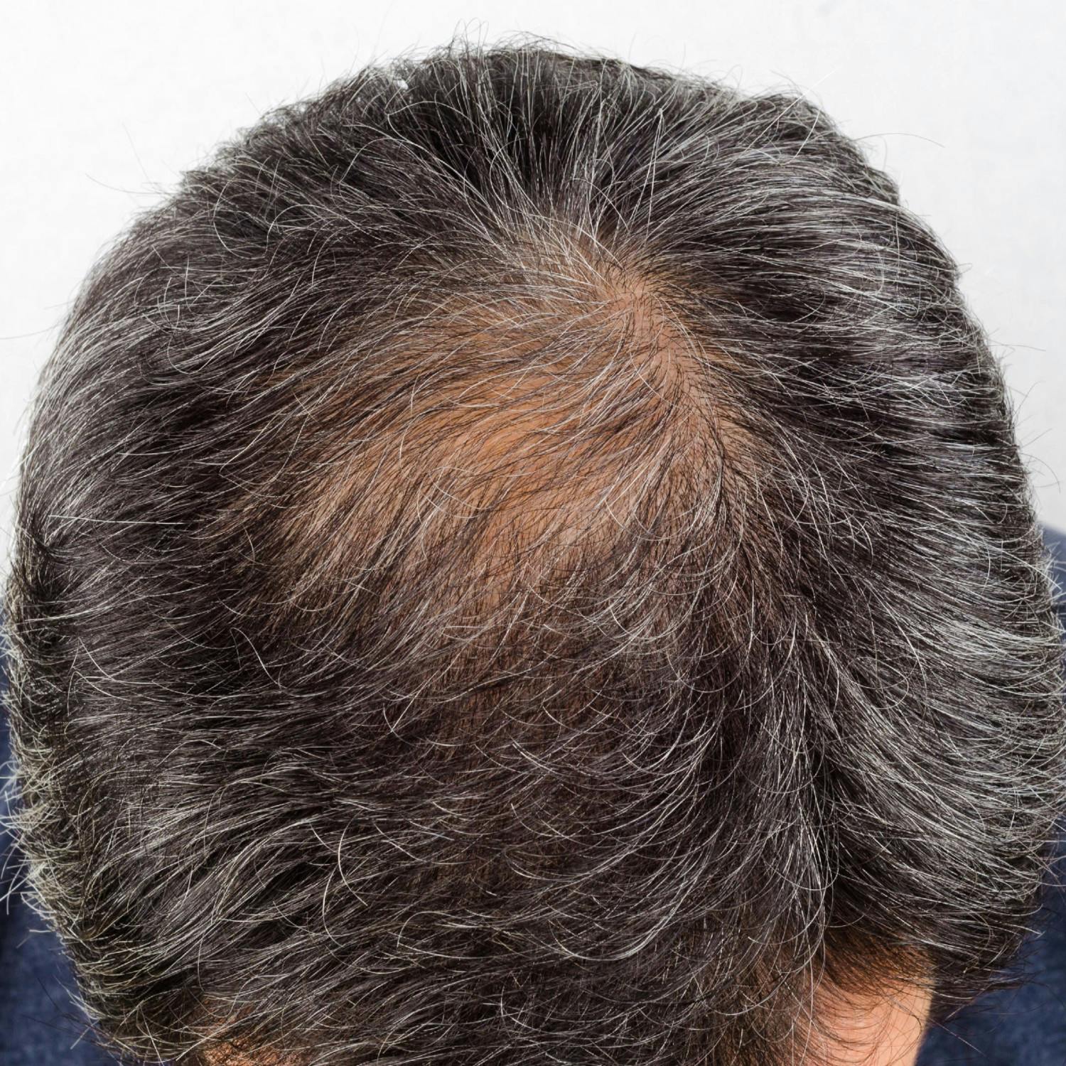 The stigma surrounding male hair loss