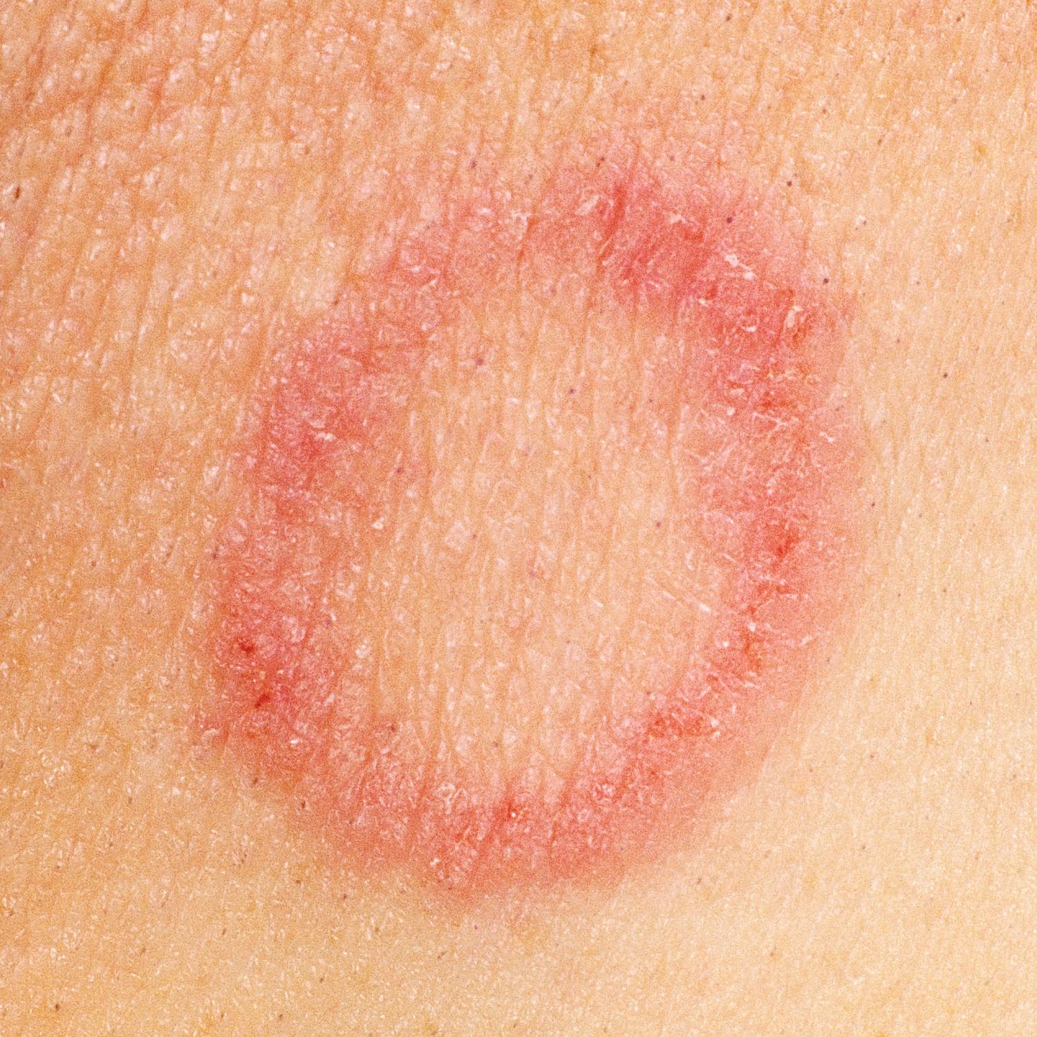 Kids Clinic: Treating Ringworm