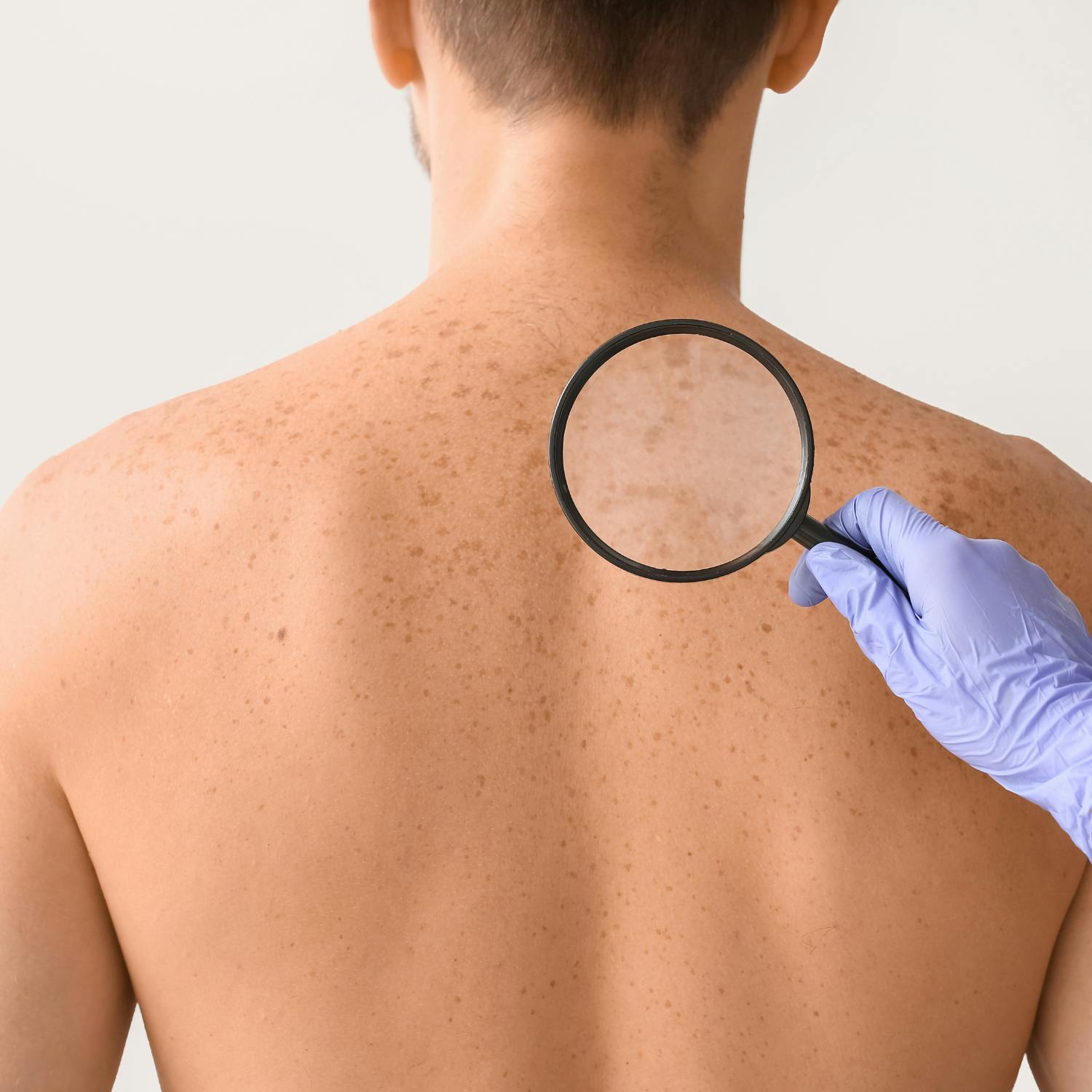 Could you spot the signs of melanoma?