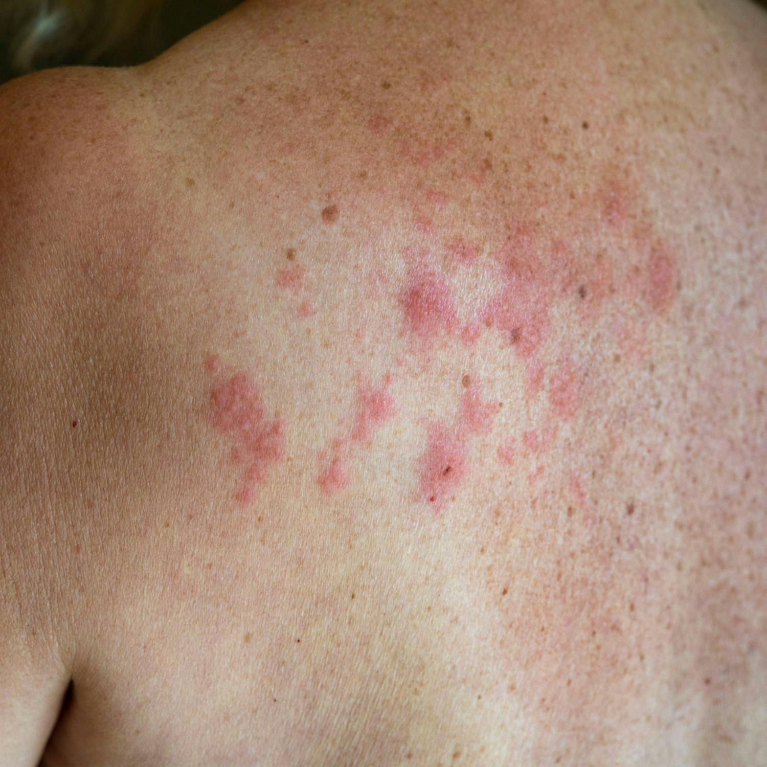 Why shingles is rising amongst millennial women