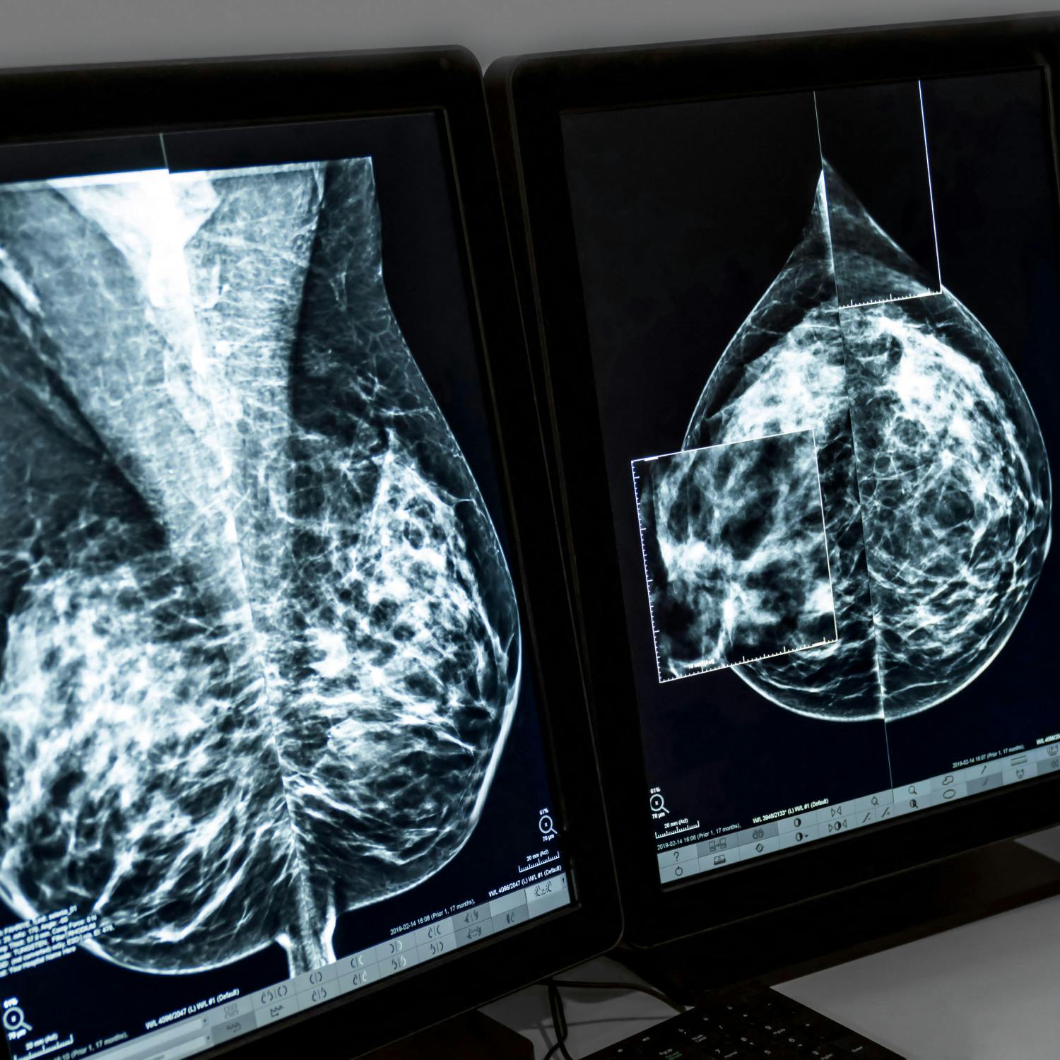 How effective can AI be in medical screening?