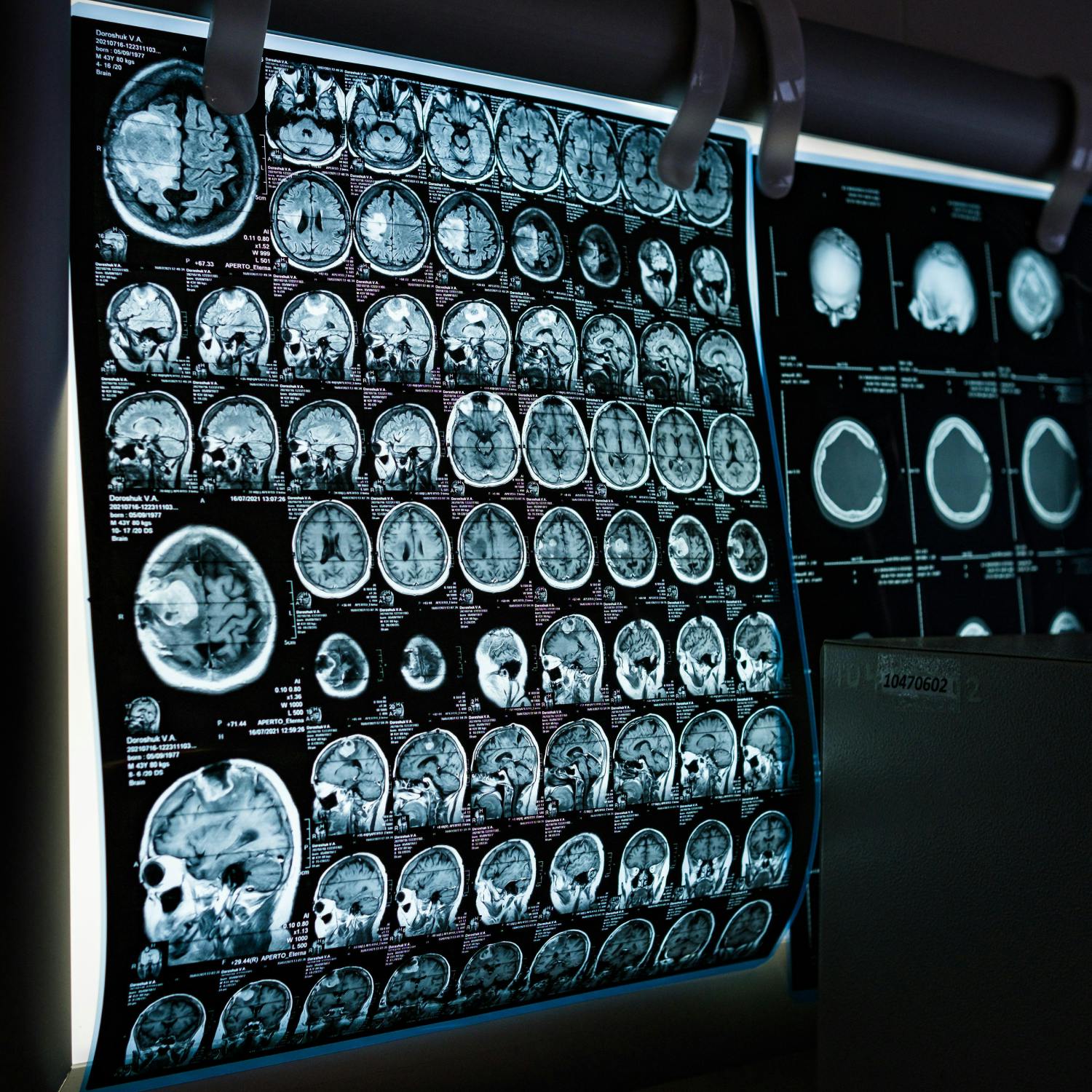 How to deal with ‘scanxiety’