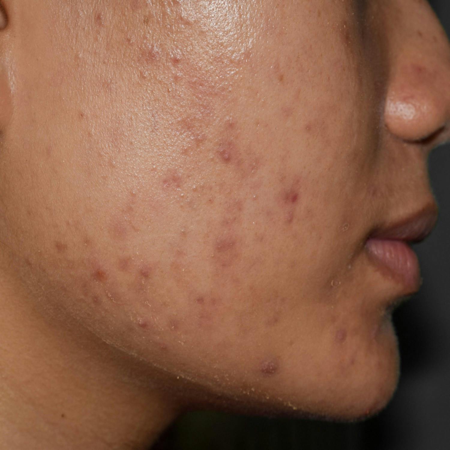 The problems with access to acne medication