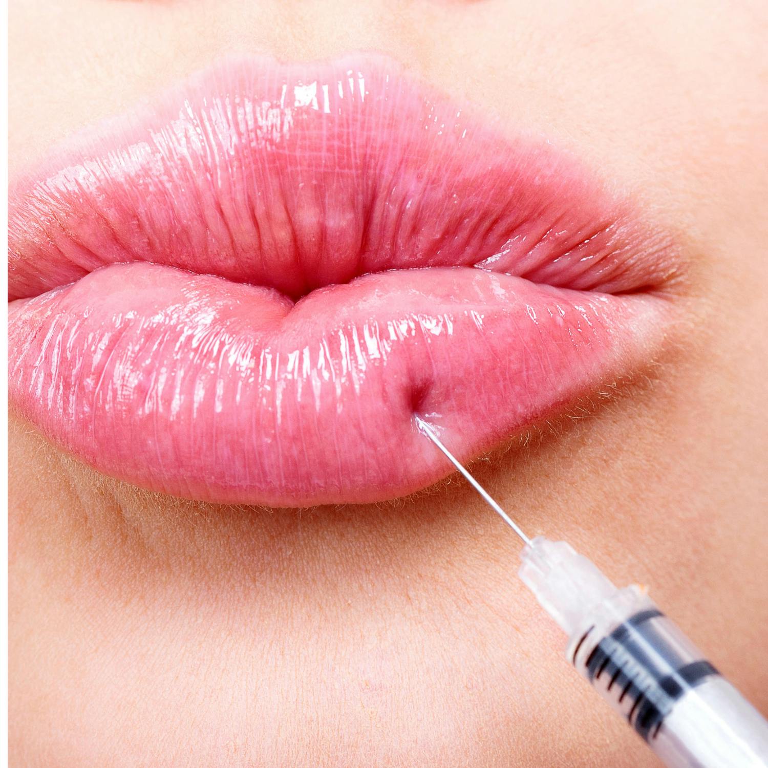 Where is there still no lip filler regulation?
