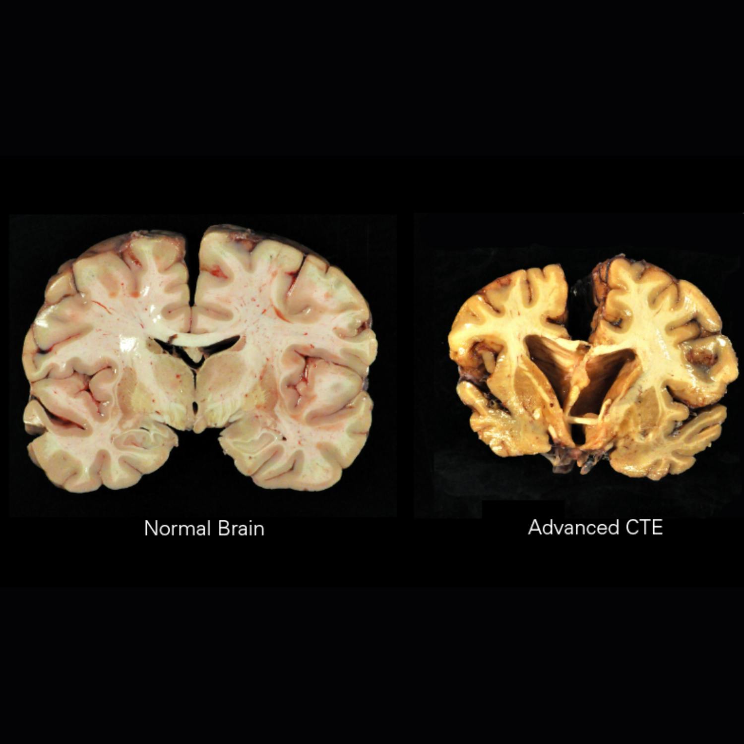 The causes and effects of CTE The causes and effects of CTE